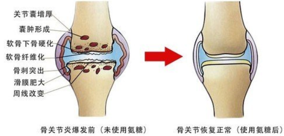 氨糖软骨素钙片哪个厂家的好？你选对了么？