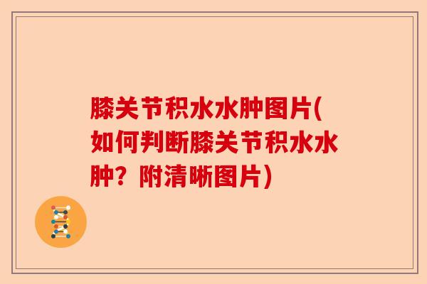 膝关节积水水肿图片(如何判断膝关节积水水肿？附清晰图片)-第1张图片-关节保镖