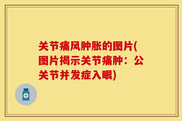 关节痛风肿胀的图片(图片揭示关节痛肿:公关节并发症入眼)-第1张图片-关节保镖 关节痛风肿胀的图片(图片揭示关节痛肿:公关节并发症入眼)-第1张图片-关节保镖